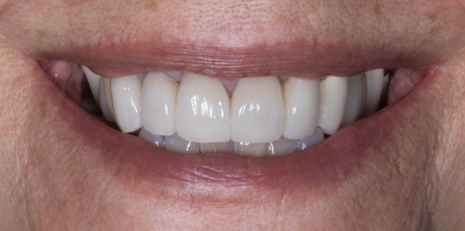 Close up of flawless teeth after full mouth reconstruction